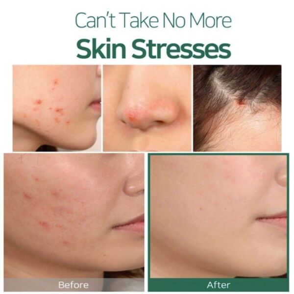 30 Days Miracle Tea Tree Clear Spot Oil 2